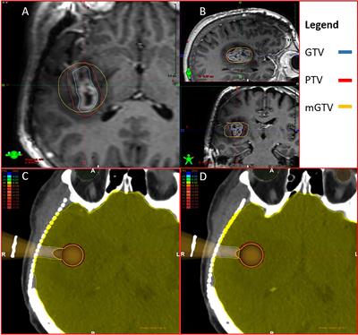 Dosimetric Comparison of Upfront Boosting With Stereotactic Radiosurgery Versus Intraoperative Radiotherapy for Glioblastoma